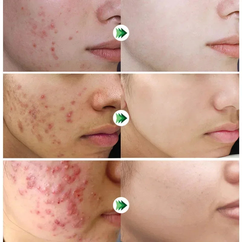 Crème rétrécissante pour les pores à l'acide salicylique, élimine les grands Pores, sérum, élimine les points noirs, répare l'acné, raffermissement, soins pour la peau, cosmétiques