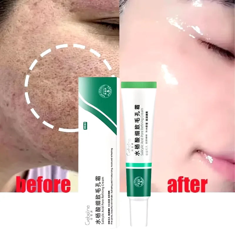 Crème rétrécissante pour les pores à l'acide salicylique, élimine les grands Pores, sérum, élimine les points noirs, répare l'acné, raffermissement, soins pour la peau, cosmétiques
