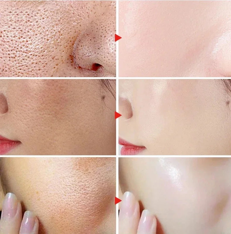 Sérum pour le visage anti-acidité, rétrécissement des pores, élimination des points noirs, contrôle de l'acné, réparation de l'huile, essence hydratante, nourrit les pores, raffermissant, soin du visage