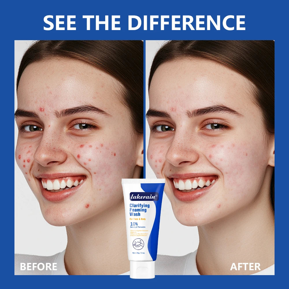 Lavage moussant contre l'acné, peroxyde de benzoyl, 10% Maximum antimicrobie, contrôle de l'huile, réduit les rougeurs, nettoyage en profondeur pour les soins de la peau du visage et du corps
