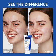 Lavage moussant contre l'acné, peroxyde de benzoyl, 10% Maximum antimicrobie, contrôle de l'huile, réduit les rougeurs, nettoyage en profondeur pour les soins de la peau du visage et du corps