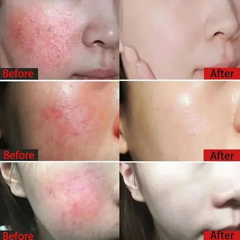 Crème réparatrice pour les rougeurs du visage, améliore la sécheresse de la peau sensible, hydratante, Lotion apaisante, élimination de la Rosacea, cosmétiques coréens