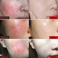 Crème réparatrice pour les rougeurs du visage, améliore la sécheresse de la peau sensible, hydratante, Lotion apaisante, élimination de la Rosacea, cosmétiques coréens