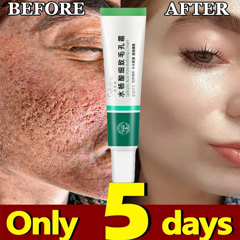 Crème rétrécissante pour les pores à l'acide salicylique, élimine les grands Pores, sérum, élimine les points noirs, répare l'acné, raffermissement, soins pour la peau, cosmétiques