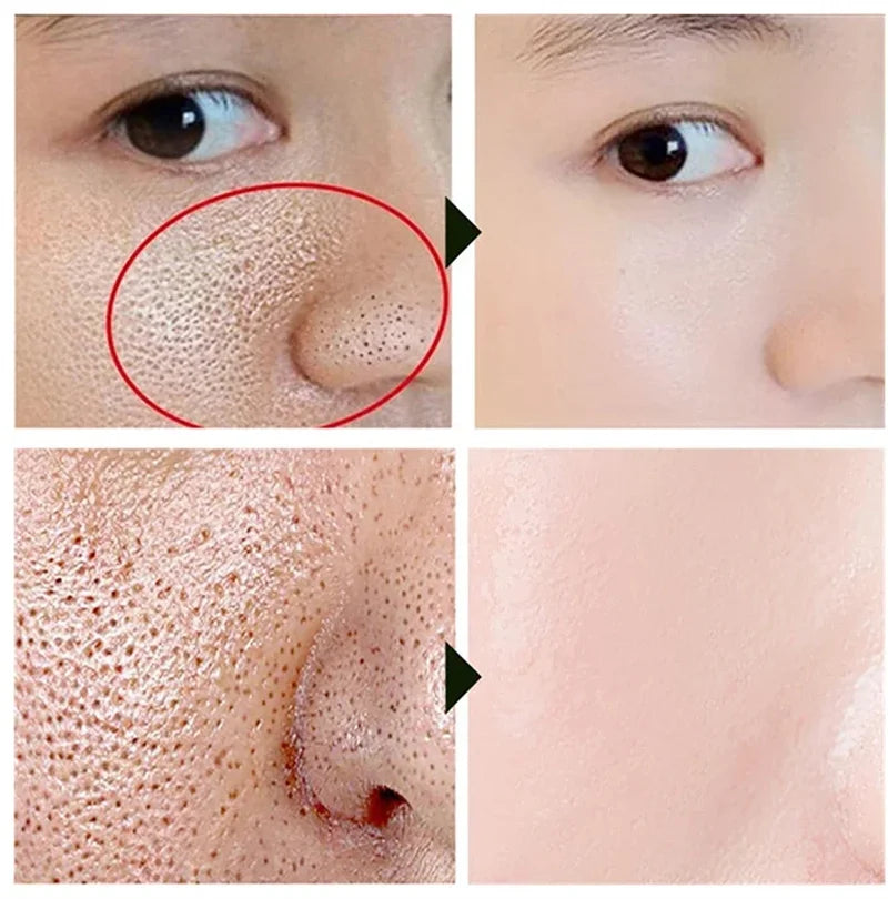 Sérum rétrécissement des pores à l'acide salicylique, élimination rapide des grands Pores, élimine les points noirs, l'acné, resserre la peau lisse, produit de soins coréen