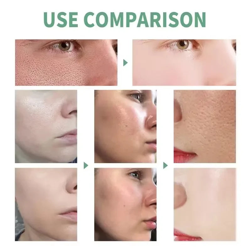 Sérum pour le visage anti-acidité, rétrécissement des pores, élimination des points noirs, contrôle de l'acné, réparation de l'huile, essence hydratante, nourrit les pores, raffermissant, soin du visage