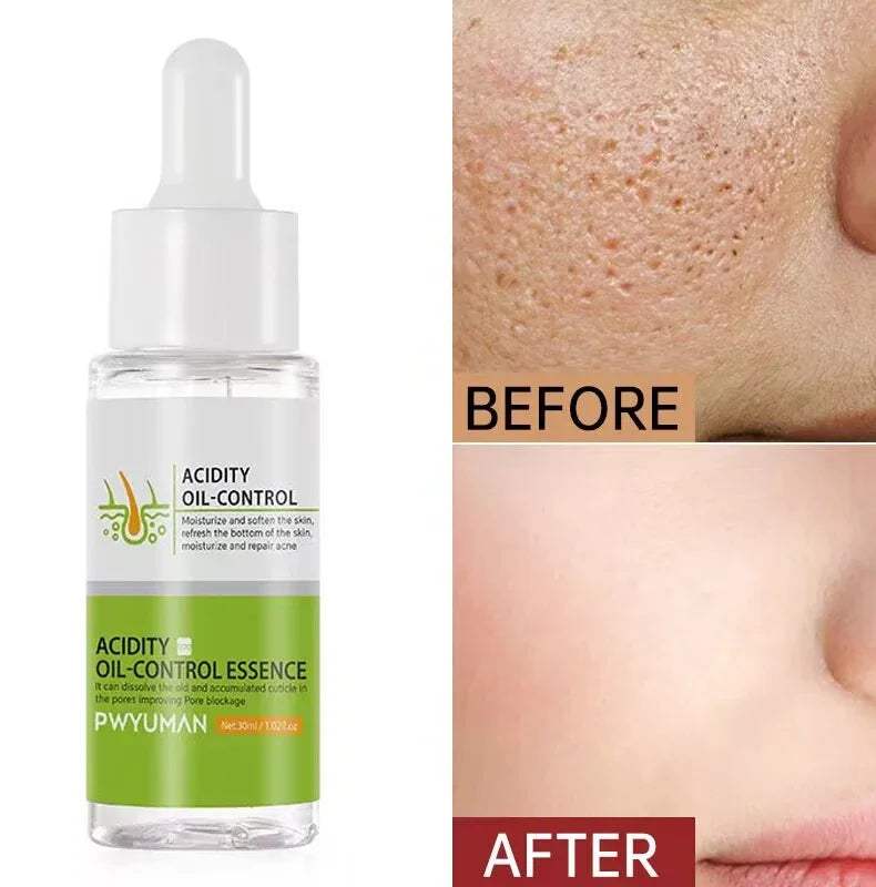 Sérum pour le visage anti-acidité, rétrécissement des pores, élimination des points noirs, contrôle de l'acné, réparation de l'huile, essence hydratante, nourrit les pores, raffermissant, soin du visage