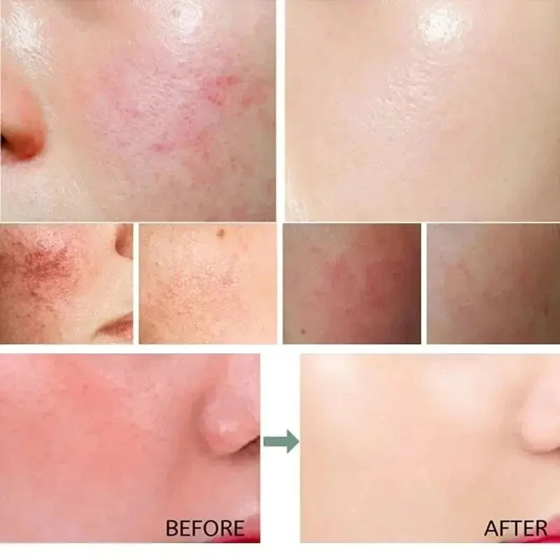 Crème réparatrice pour les rougeurs du visage, améliore la sécheresse de la peau sensible, hydratante, Lotion apaisante, élimination de la Rosacea, cosmétiques coréens
