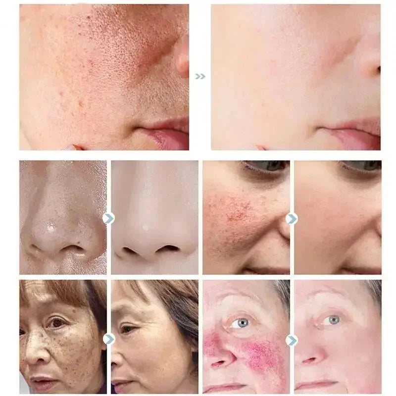 Crème réparatrice pour les rougeurs du visage, améliore la sécheresse de la peau sensible, hydratante, Lotion apaisante, élimination de la Rosacea, cosmétiques coréens