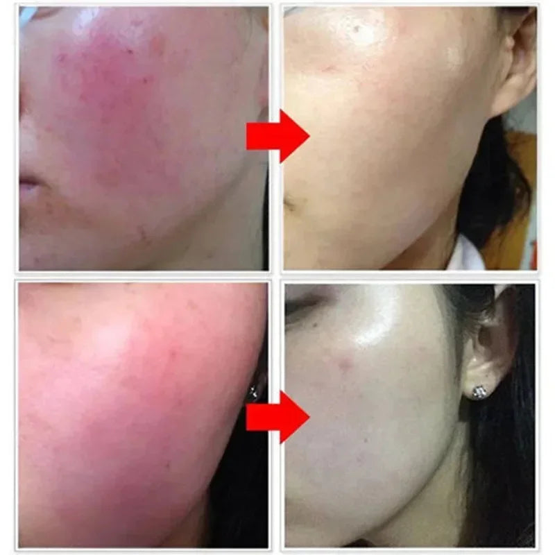 Crème réparatrice pour les rougeurs du visage, améliore la sécheresse de la peau sensible, hydratante, Lotion apaisante, élimination de la Rosacea, cosmétiques coréens