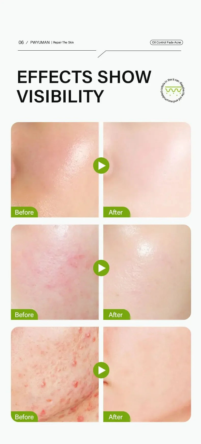 Sérum pour le visage anti-acidité, rétrécissement des pores, élimination des points noirs, contrôle de l'acné, réparation de l'huile, essence hydratante, nourrit les pores, raffermissant, soin du visage