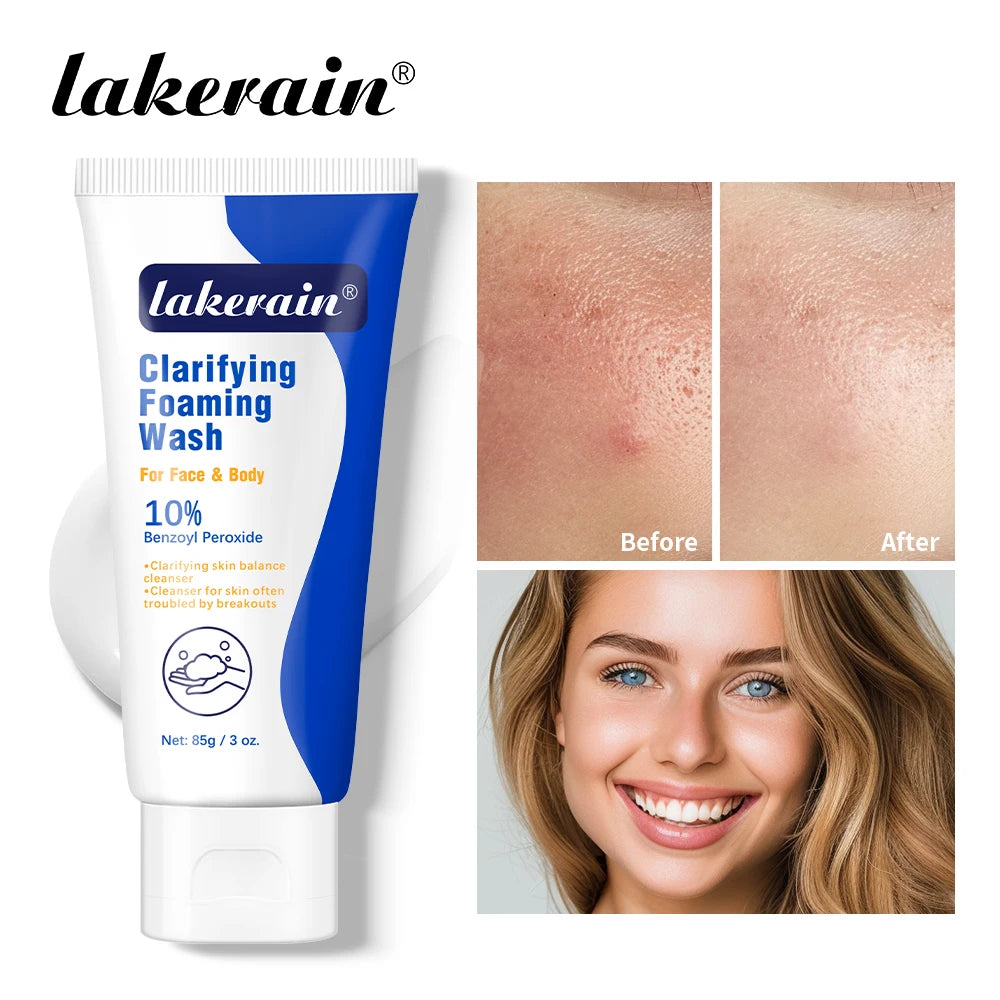 Lavage moussant contre l'acné, peroxyde de benzoyl, 10% Maximum antimicrobie, contrôle de l'huile, réduit les rougeurs, nettoyage en profondeur pour les soins de la peau du visage et du corps