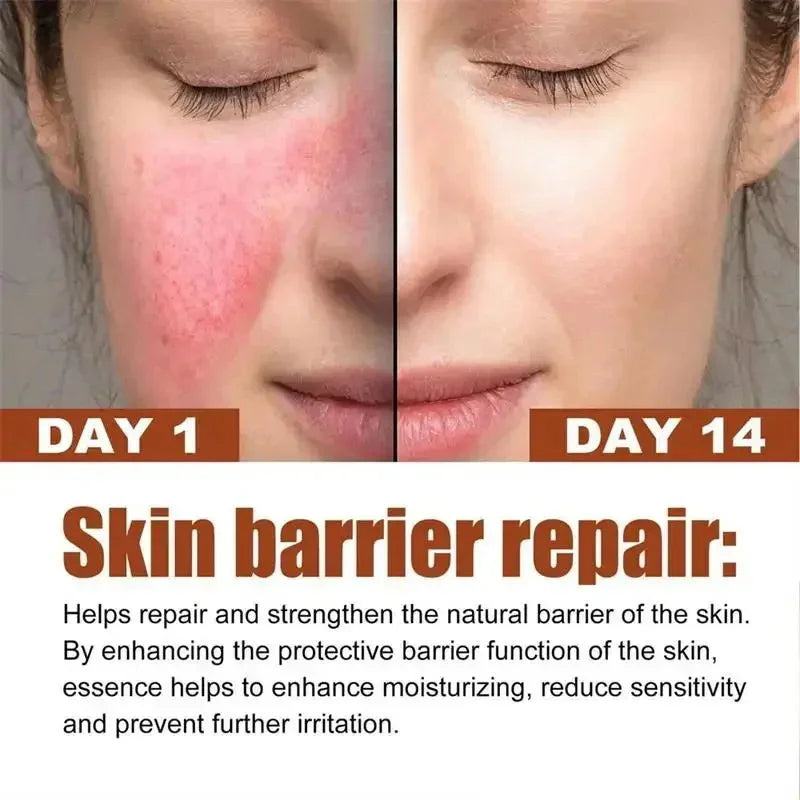 Crème réparatrice pour les rougeurs du visage, améliore la sécheresse de la peau sensible, hydratante, Lotion apaisante, élimination de la Rosacea, cosmétiques coréens
