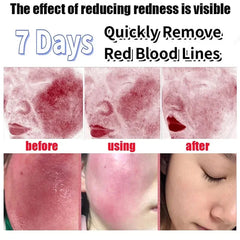 Crème réparatrice pour les rougeurs du visage, améliore la sécheresse de la peau sensible, hydratante, Lotion apaisante, élimination de la Rosacea, cosmétiques coréens