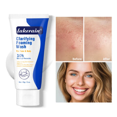 Lavage moussant contre l'acné, nettoyage en profondeur, débouche les Pores, prévient les défauts pour les hydratants du visage et du corps, réduit les rougeurs, soins pour la peau
