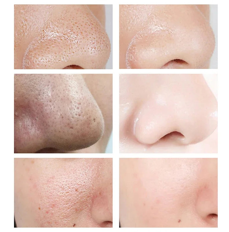 Sérum pour le visage anti-acidité, rétrécissement des pores, élimination des points noirs, contrôle de l'acné, réparation de l'huile, essence hydratante, nourrit les pores, raffermissant, soin du visage