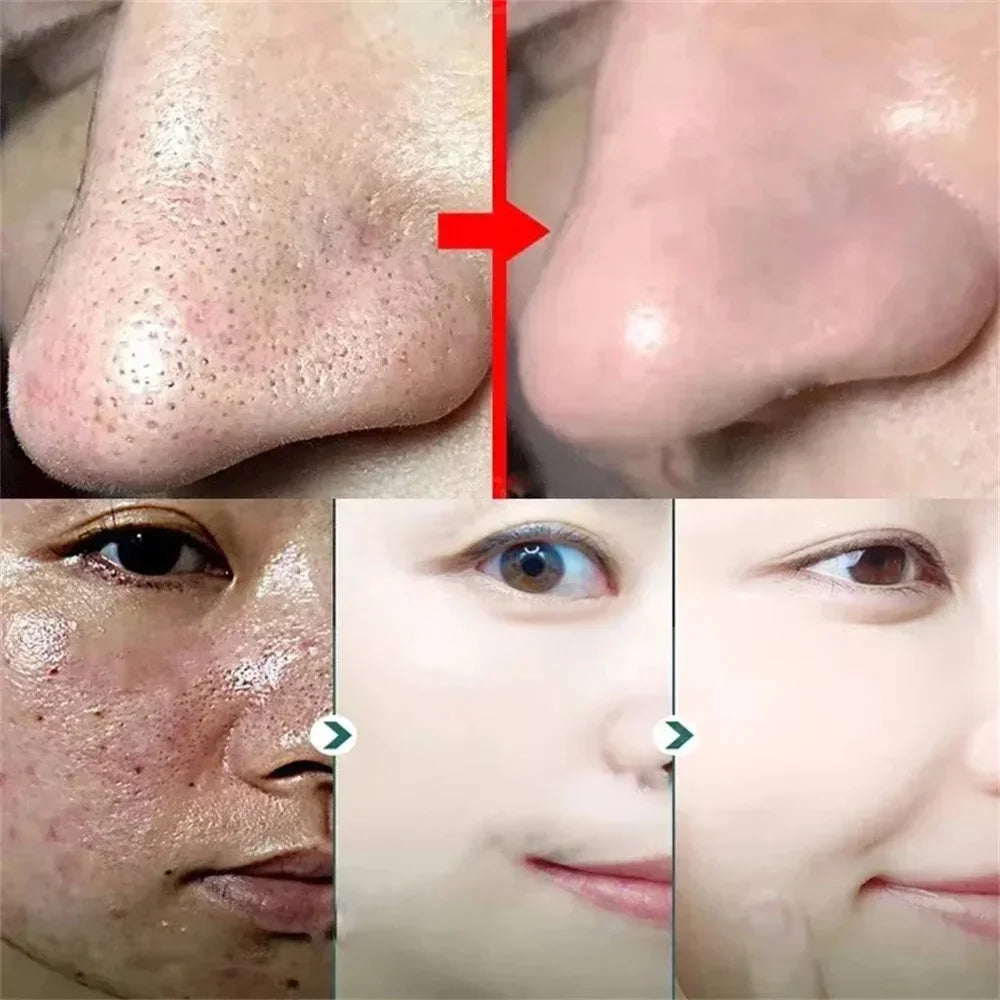 Sérum rétrécissement des pores à l'acide salicylique, élimination rapide des grands Pores, élimine les points noirs, l'acné, resserre la peau lisse, produit de soins coréen