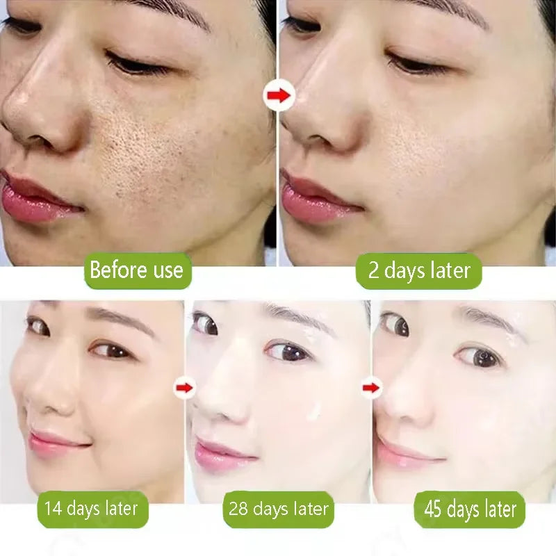 Sérum pour le visage anti-acidité, rétrécissement des pores, élimination des points noirs, contrôle de l'acné, réparation de l'huile, essence hydratante, nourrit les pores, raffermissant, soin du visage