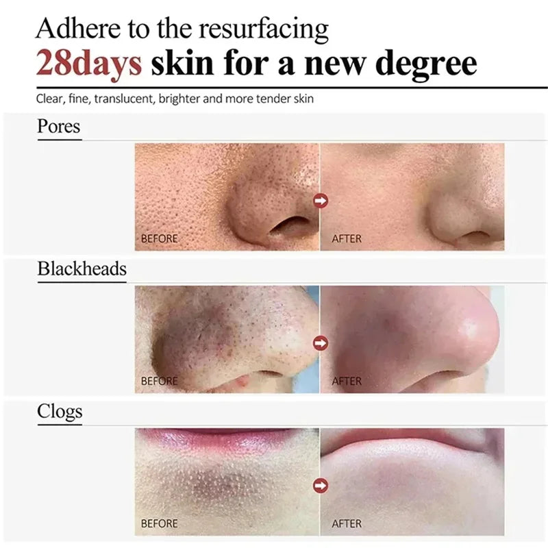Sérum rétrécissement des pores à l'acide salicylique, élimination rapide des grands Pores, élimine les points noirs, l'acné, resserre la peau lisse, produit de soins coréen