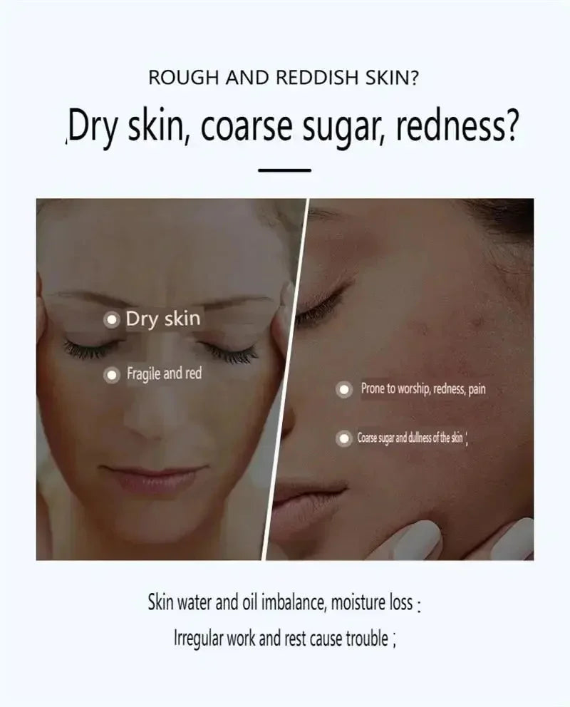 Crème réparatrice pour les rougeurs du visage, améliore la sécheresse de la peau sensible, hydratante, Lotion apaisante, élimination de la Rosacea, cosmétiques coréens