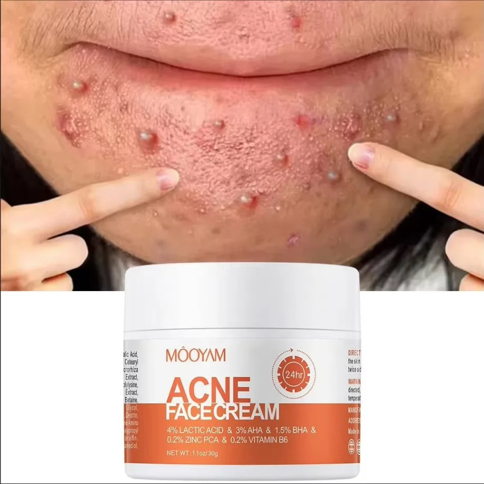 Crème de traitement de l'acné à base de plantes, crème Anti-acné pour le visage, élimination des boutons, taches, contrôle du sébum, rétrécissement des Pores, crème de soin hydratante pour la peau