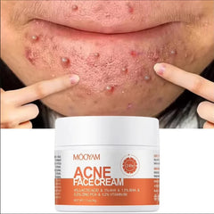 Crème de traitement de l'acné à base de plantes, crème Anti-acné pour le visage, élimination des boutons, taches, contrôle du sébum, rétrécissement des Pores, crème de soin hydratante pour la peau